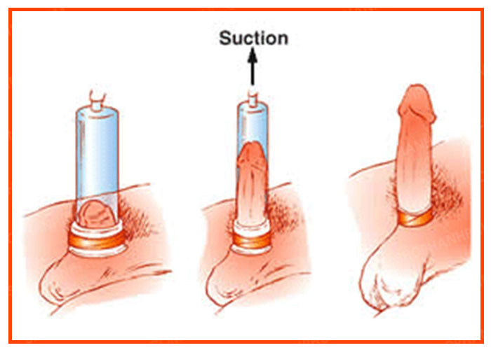 Máy tập penis pump làm to và kéo dài dương vật trong thời gian ngắn nhất